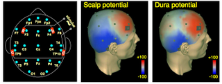 Illustration for article titled Lucid Dreaming Can Be Induced By Zapping Brains With Gamma Waves